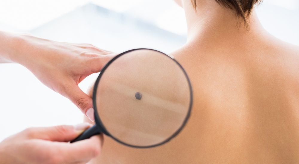 Cáncer de Piel Importancia de la prevención y el diagnóstico