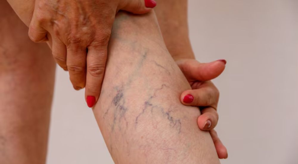 Cómo tratar las várices y mejorar tu salud vascular